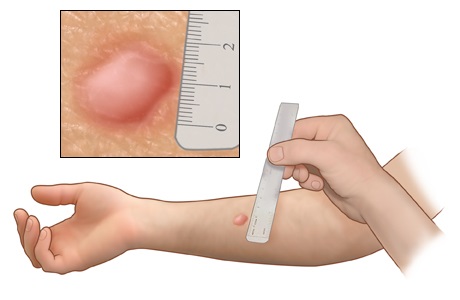 Skin Prick Allergy Test - WebMD