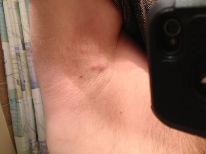 swollen lymph nodes under arm