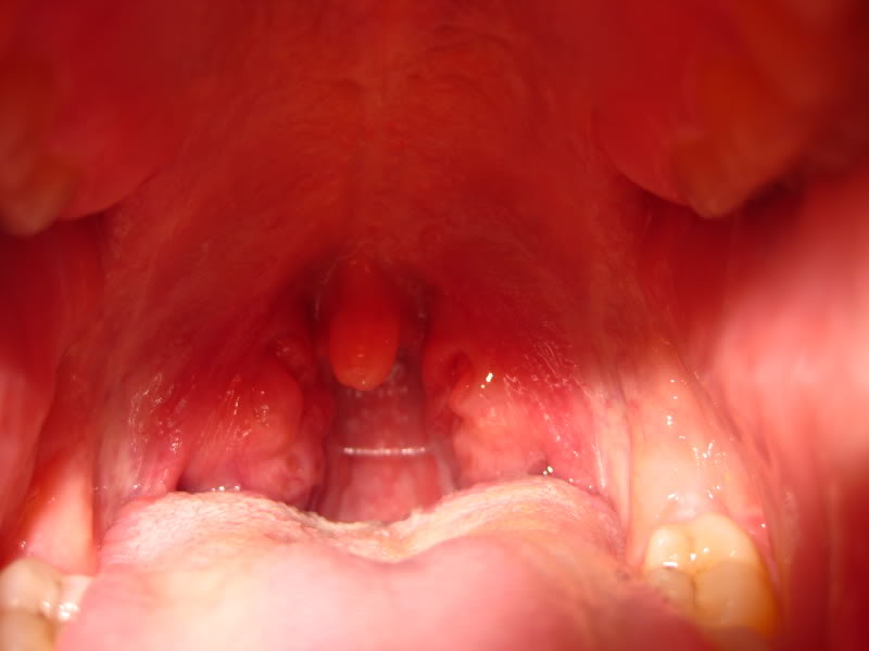 One Side Of Throat Swollen 72