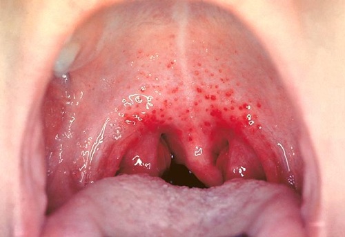 Smooth Red Patch In Mouth