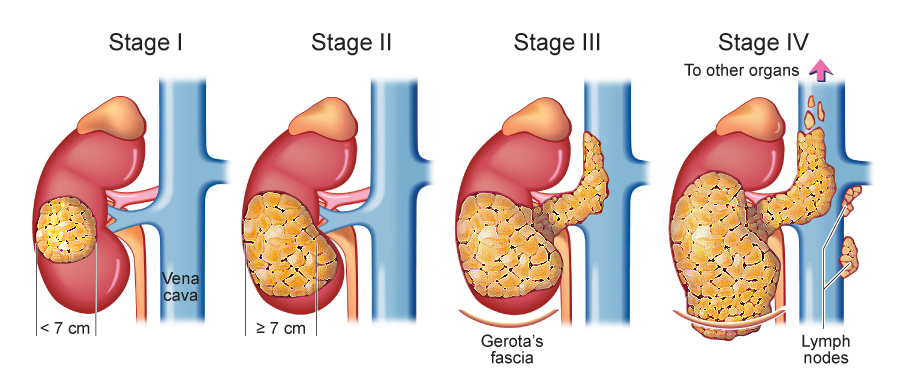 What is the prognosis of stage 3 renal cell cancer?