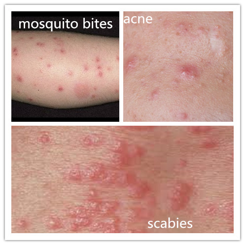 what do scabie bites look like