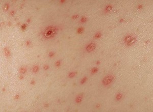 What are some visual characteristics of scabies rash?
