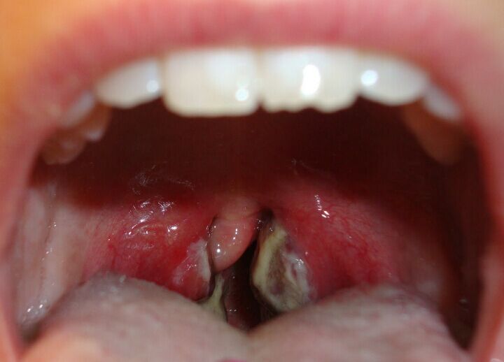 What Is The Cause Of Strep Throat 17