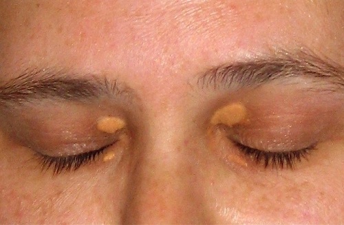 What Are the White Spots Under Eyes? New Health Advisor