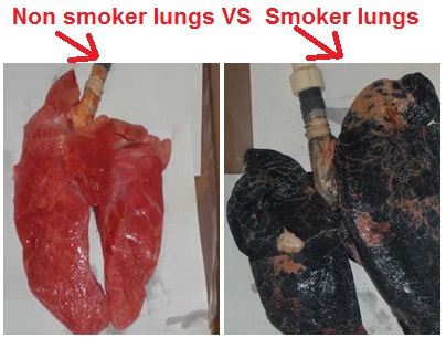 Резултат с изображение за smoker lungs