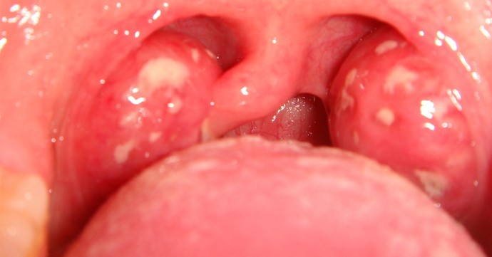 Bad Taste In Throat When Swallowing 86