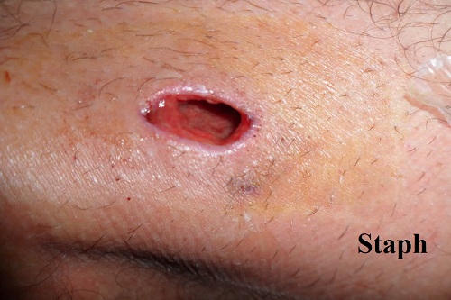 Staph infections - Mayo Clinic