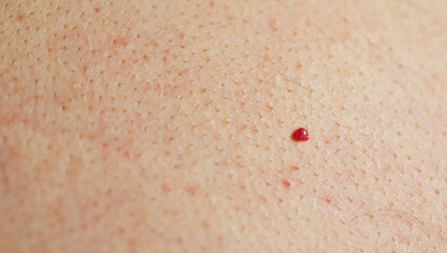 Spider Angioma Causes - Doctor answers on HealthTap