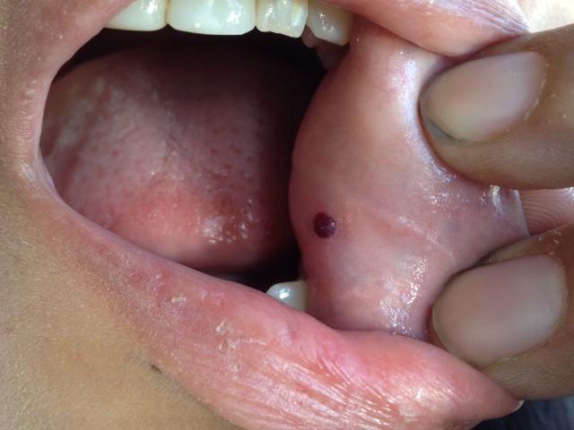 blood blister on lip pictures