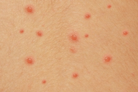 Chicken Pox Symptoms and Treatments - Verywell