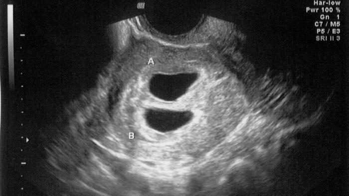 What to Expect for Ultrasound at 4 Weeks: Pictures and ...