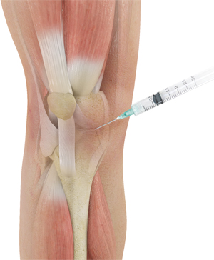 Intra articular steroid injection knee joint