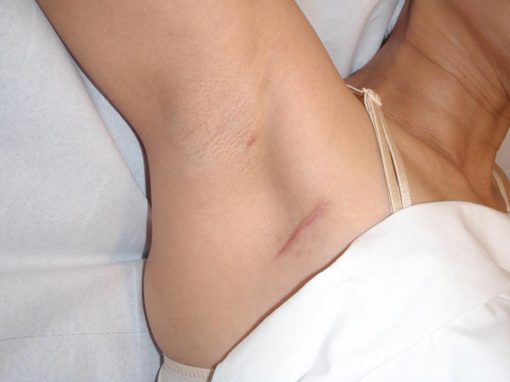 Chest rash and Skin bumps - Symptom Checker - check ...