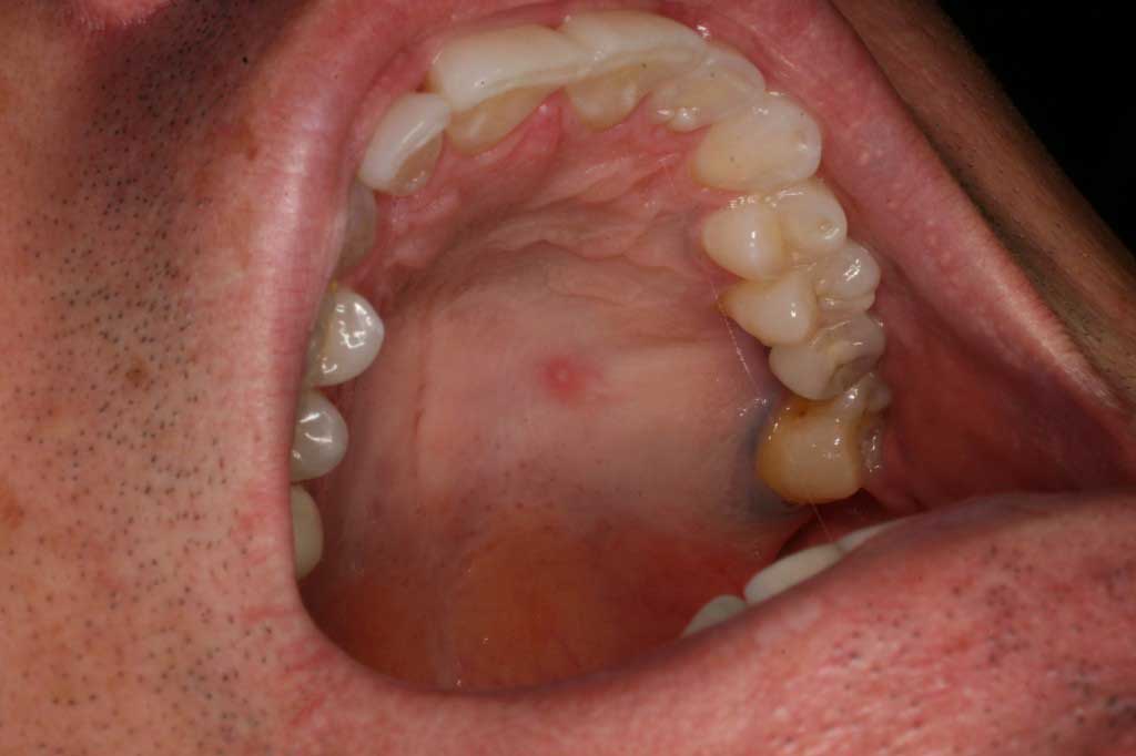 Hard Lump Inside Mouth 15