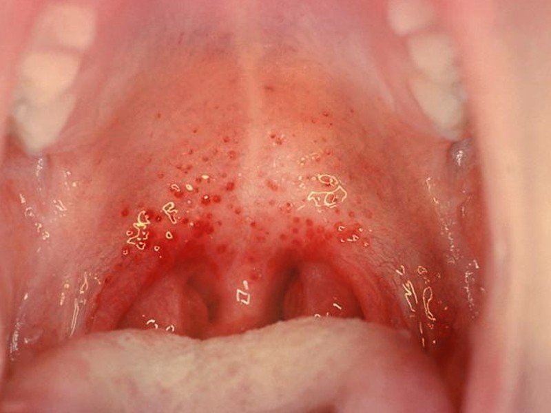 herpes back of throat #10