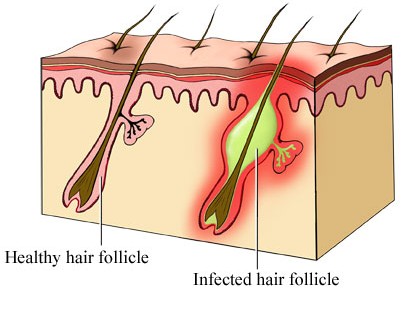 Folliculitis Treatment, Causes, and Home Remedies