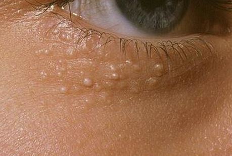 White Bumps Under Eyes: 10 Remedies to Help | New Health Advisor