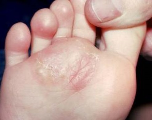 How to Remove Soft Corns Between My Toes | LIVESTRONG.COM