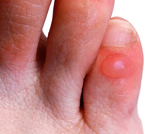Itchy Red Bumps On My Toe Symptoms - HealthTap