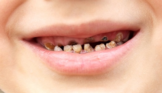 sintomas de diente podrido