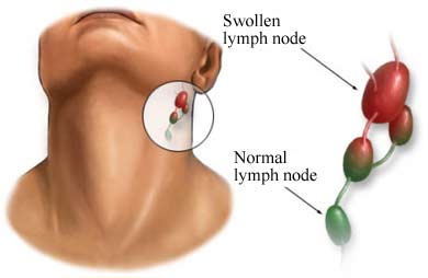 Are Swollen Lymph Nodes and HIV Connected? | New Health ...