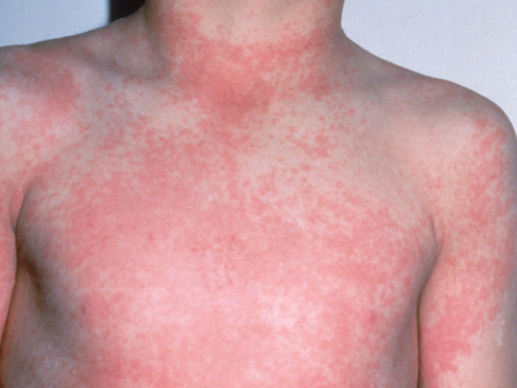 Scarlet Fever in Children: Symptoms and Treatments | New ...