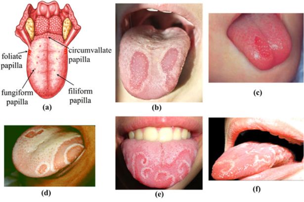 Geographic tongue | Genetic and Rare Diseases Information ...