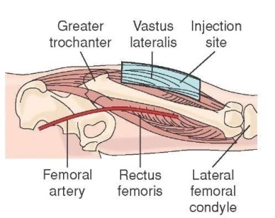 Ventrogluteal injection steroids
