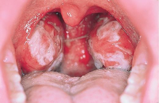 Swelling Inside The Throat 79