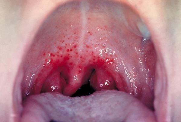 When should you see a doctor for the burning tongue disease?