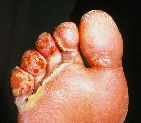 Athlete's Foot (Tinea Pedis) in Adults: Condition ...