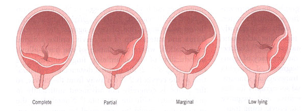 Bleeding in Pregnancy: Placenta Previa | New Health Advisor
