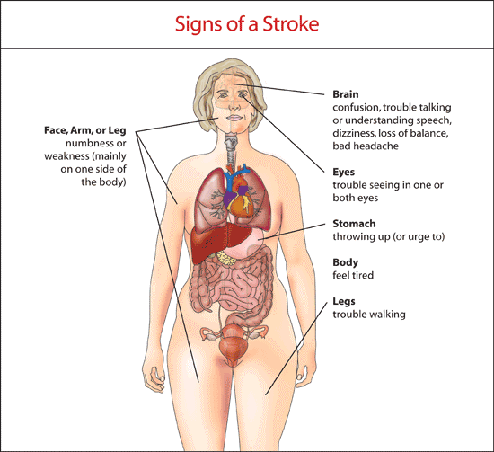 Image result for stroke