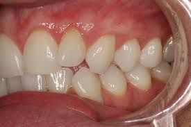 What can cause dark gums around someone's teeth?