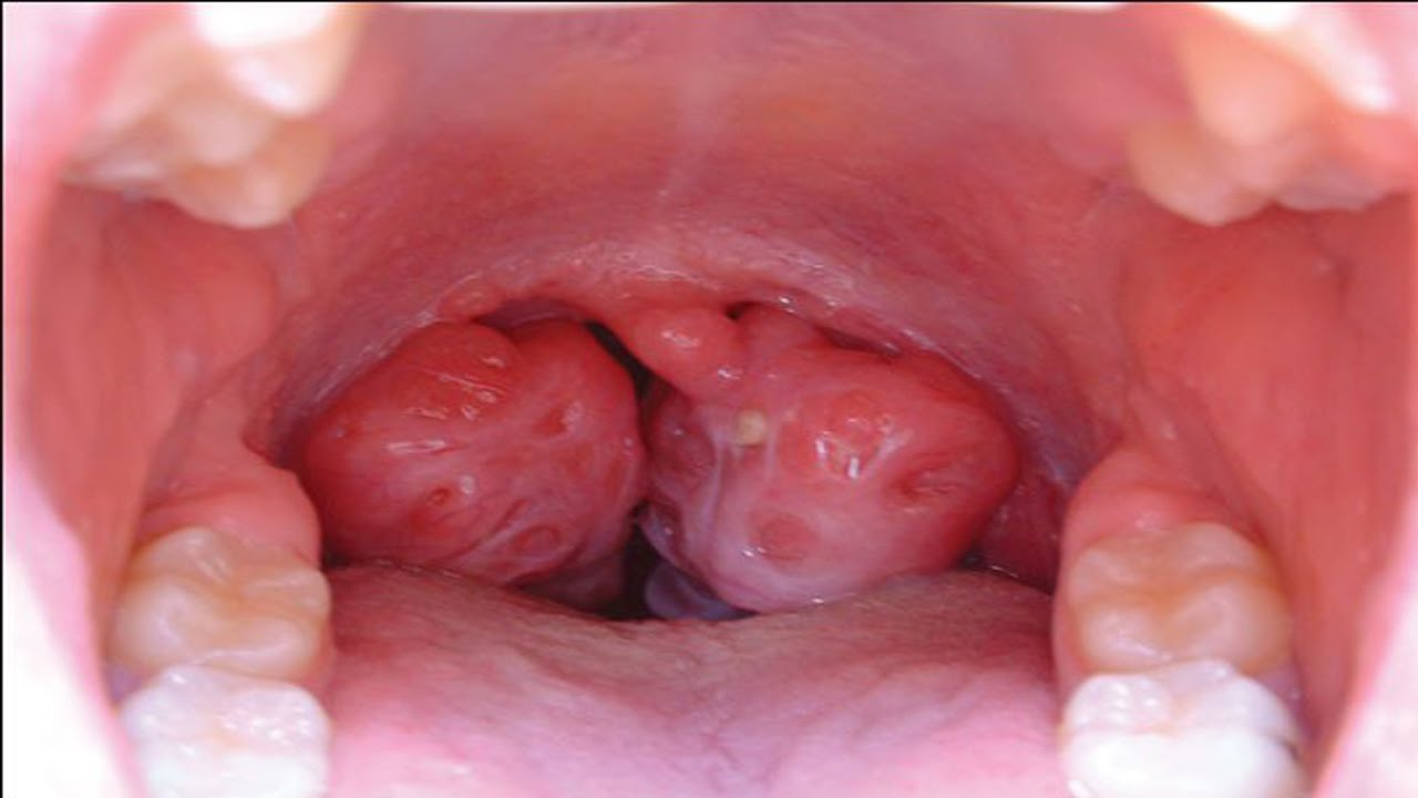 Symtoms Of Strept Throat 50