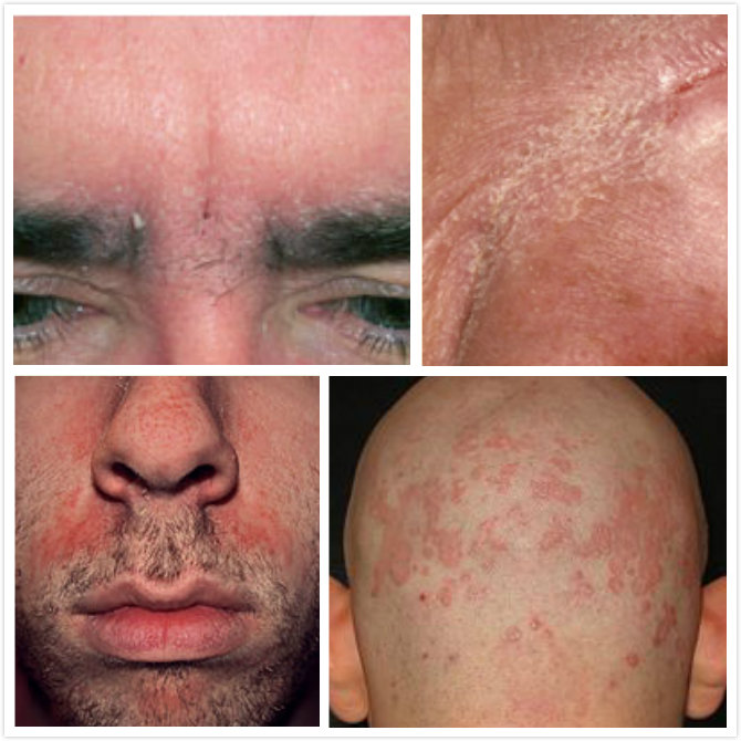 Seborrheic Dermatitis: Causes, Symptoms, and Treatments