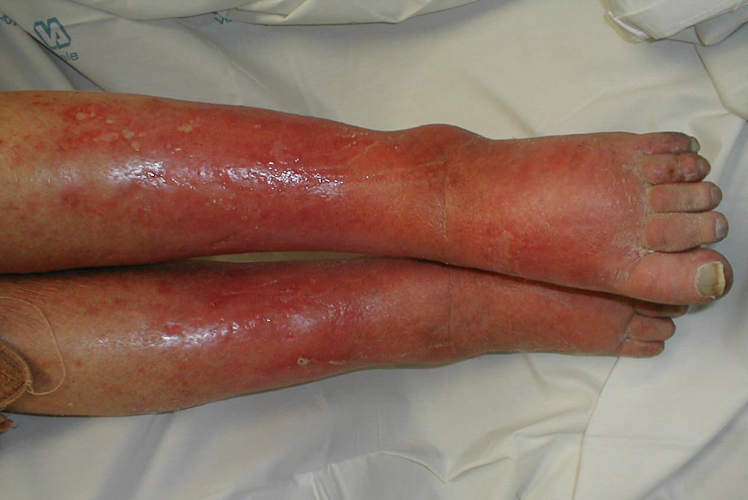 Is there an average healing time for cellulitis in the lower leg?