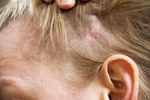How to Stop Scratching Your Head with 8 Tips | New Health Advisor