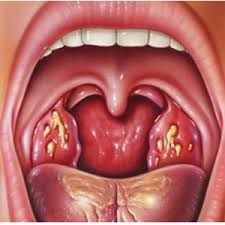 Can narrowing of the esophagus cause excess mucus in the throat and coughing?