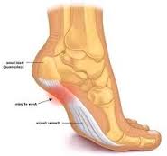 What are some causes of foot pain in the arch area?