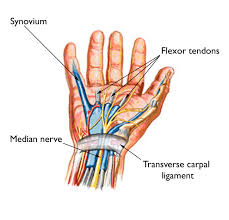 Corticosteroids injections for carpal tunnel