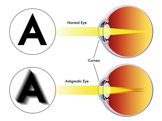 How to Correct Astigmatism Home Remedies & Medical