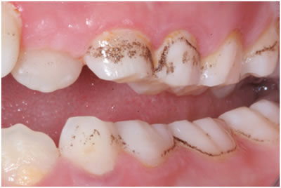 causes children's teeth turn black