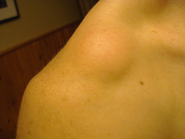 9 Possible Causes of Hard Lumps on Your Collarbone | New Health Advisor