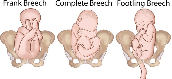 Breech Baby Development Problems: Understanding the Risks and Solutions