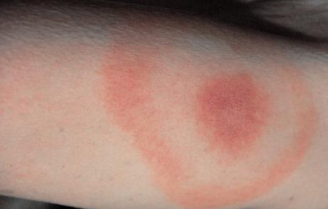 Bug Bites Pictures Slideshow: Identifying Bugs and ... - WebMD