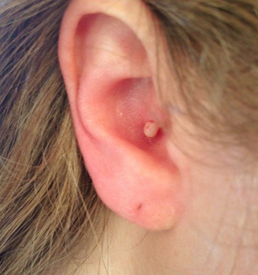 How to Get Rid of a Pimple in Ear New Health Advisor