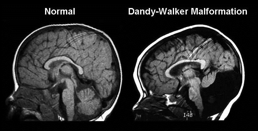 Image result for dandy walker syndrome