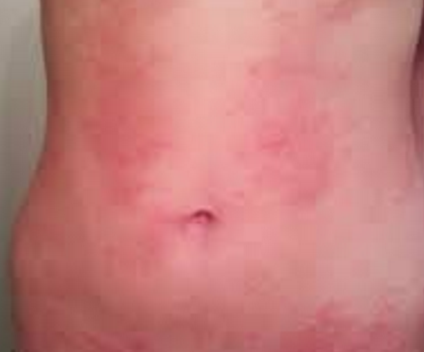 can alcohol cause hives #11